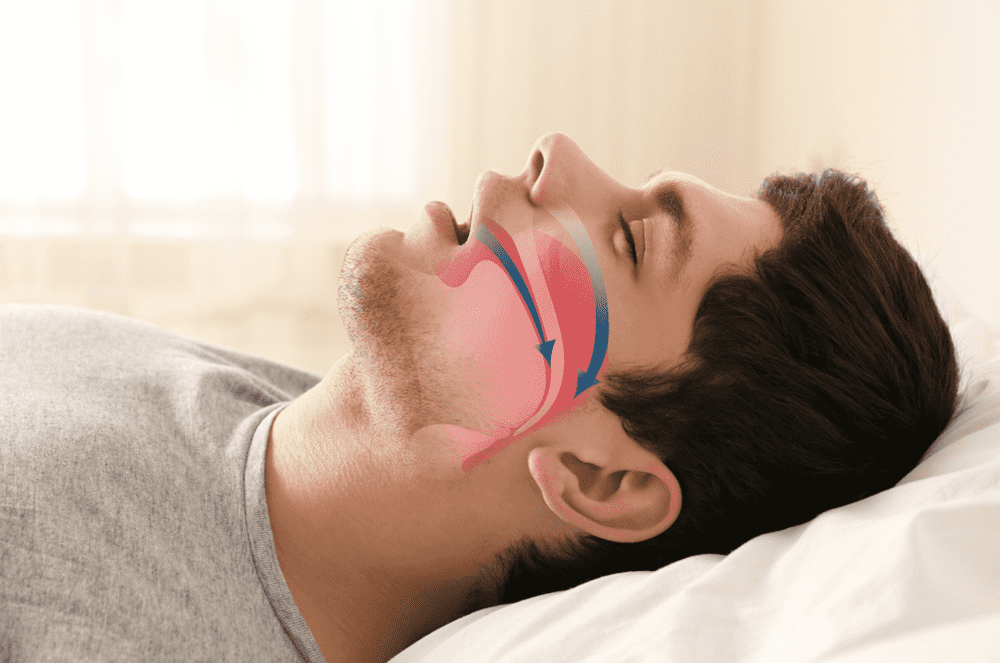 Sleep apnea and Snoring