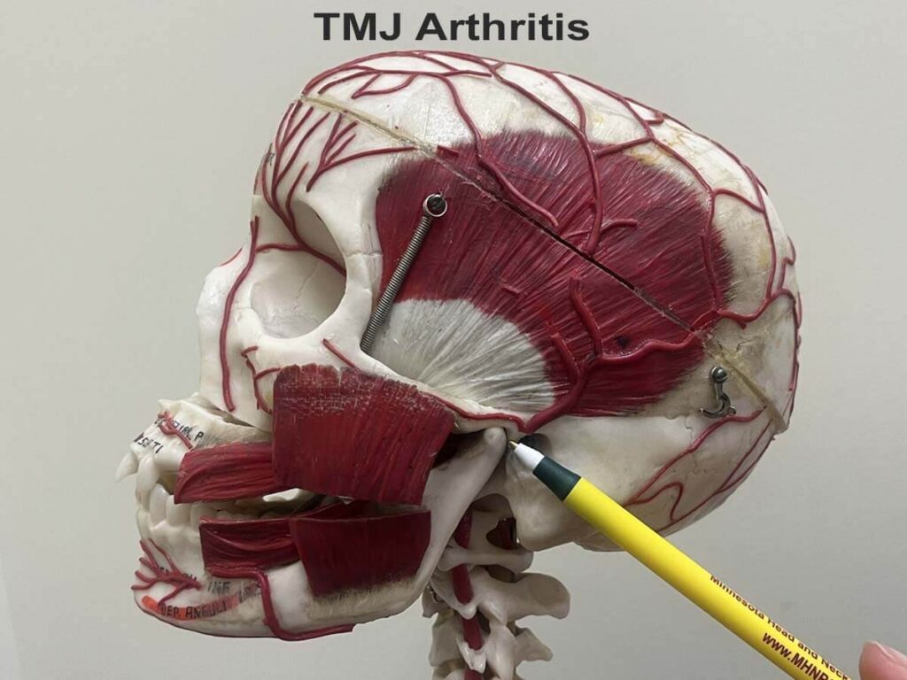 Arthritis Affects TMJ