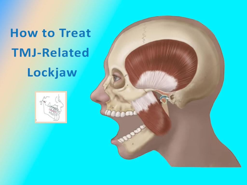 What is Lock Jaw?